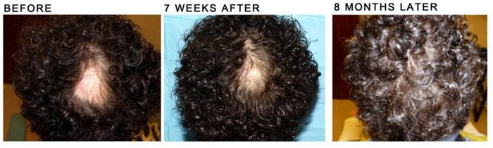 Acell + PRP results on patient with severe ALOPECIA AREATA
