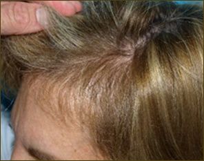 female patient 6 months after ACell hair loss injection