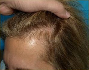 Female patient before Acell hair loss injection