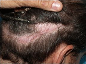 Scarring in hair donor areas before ACell treatment