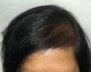 female patient 3 months after ACell treatment results