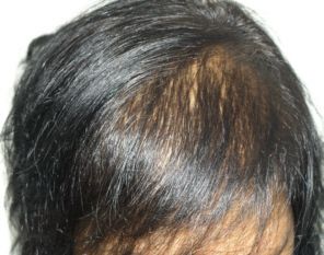 Female patient before ACell ECM hair loss treatment