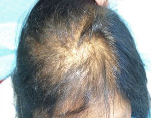 Female patient before ACell hair loss treatment