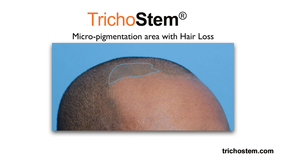 micro-pigmentation area with hair loss on 32-year-old man