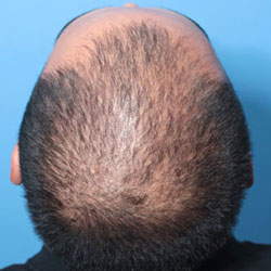 early male pattern hair loss patient