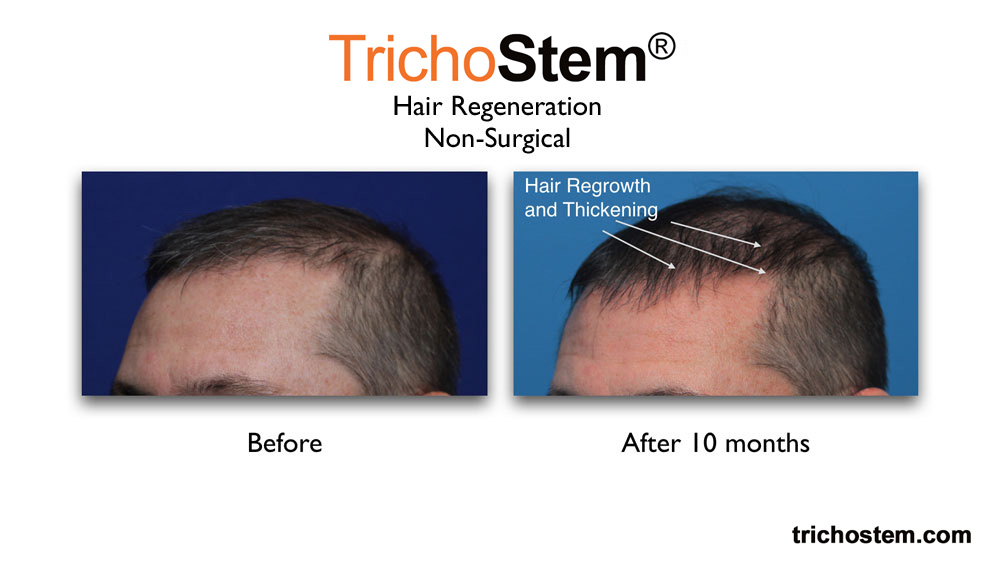 before and after hair regeneration treatment. after photo shows hair regrowth and thickening 10 months after TrichoStem™ Hair Regeneration treatment