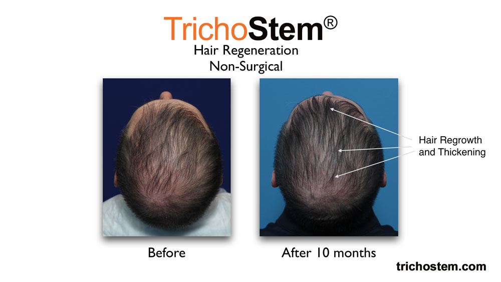 before and 10 months after TrichoStem™ Hair Regeneration treatment on late onset of hair loss on male patient