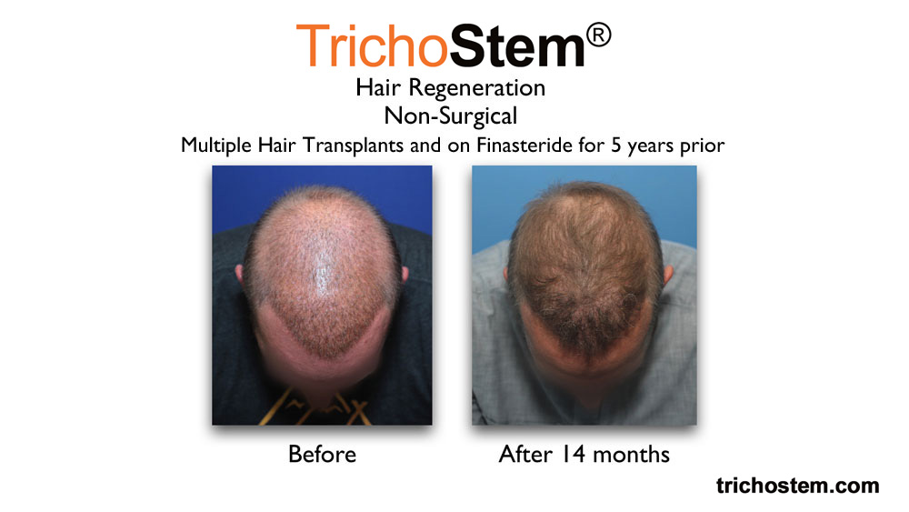 before and after TrichoStem™ Hair Regeneration treatment. 14 months after treatment shows improve hair coverage