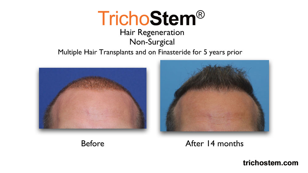 before and 15 months after TrichoStem™ Hair Regeneration treatment. After photo shows Thicker hair of male patient.