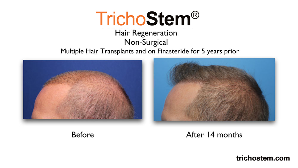 TrichoStem™ Hair Regeneration treatment on early and aggressive pattern hair loss. before and after photo