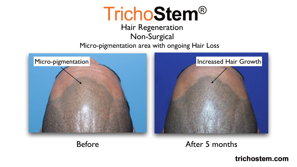 before and 5 months after TrichoStem™ Hair Regeneration treatment micro-pigmentation look less noticeable