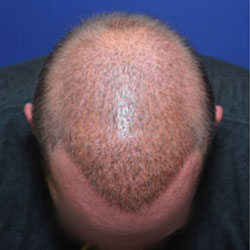 improving hair coverage after multiple hair transplants