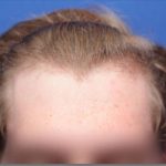 TrichoStem™ Hair Regeneration treatment on 23 years old male