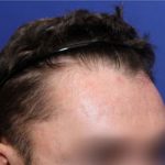 Prior finasteride use with TrichoStem™ Hair Regeneration