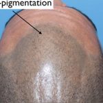 scalp micro-pigmentation with hair loss