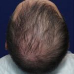 TrichoStem™ Hair Regeneration treatment of late onset hair loss