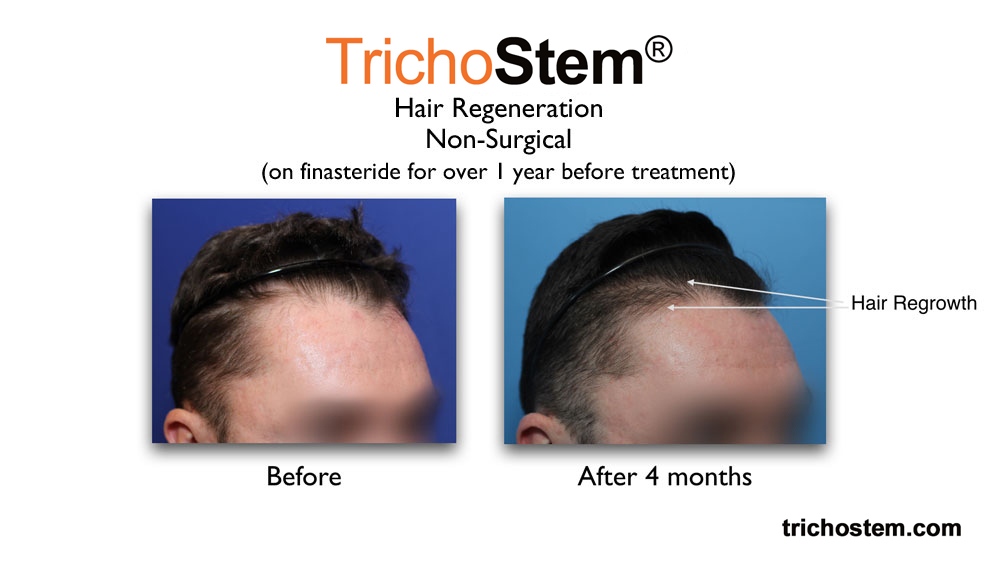 TrichoStem™ Hair Regeneration before and after treatment shows increase in frontal hair density of male patient