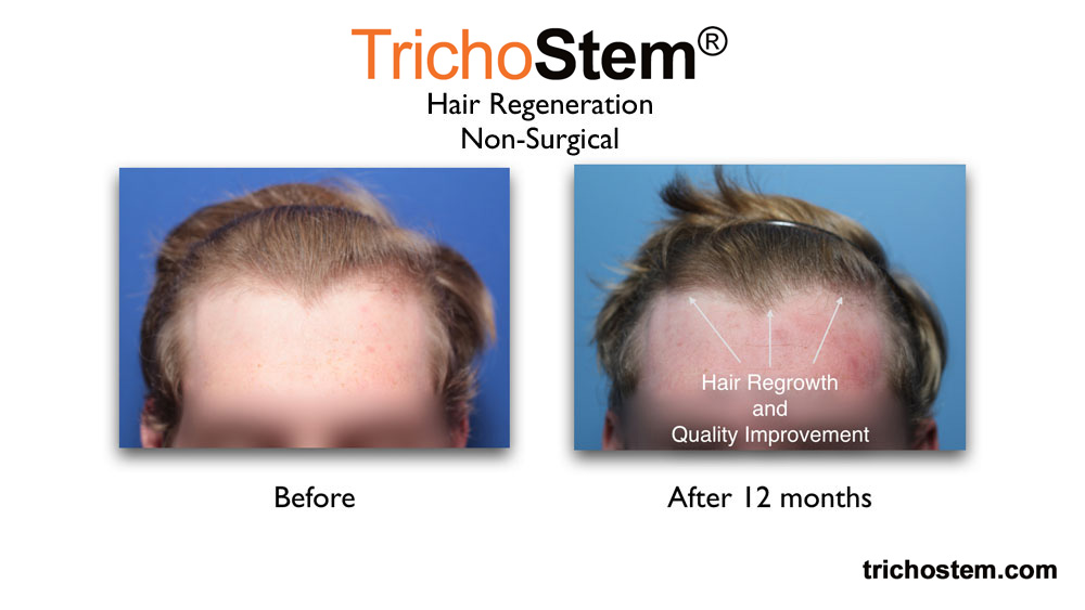before and after TrichoStem™ Hair Regeneration treatment on 23 yrs old male. hair regrowth and quality improvement on frontal hair 12 months after the treatment