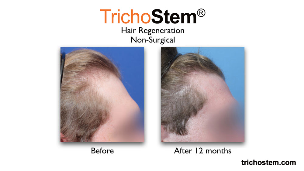 before and 12 months after TrichoStem™ Hair Regeneration treatment on 23 yrs old male - right temple view