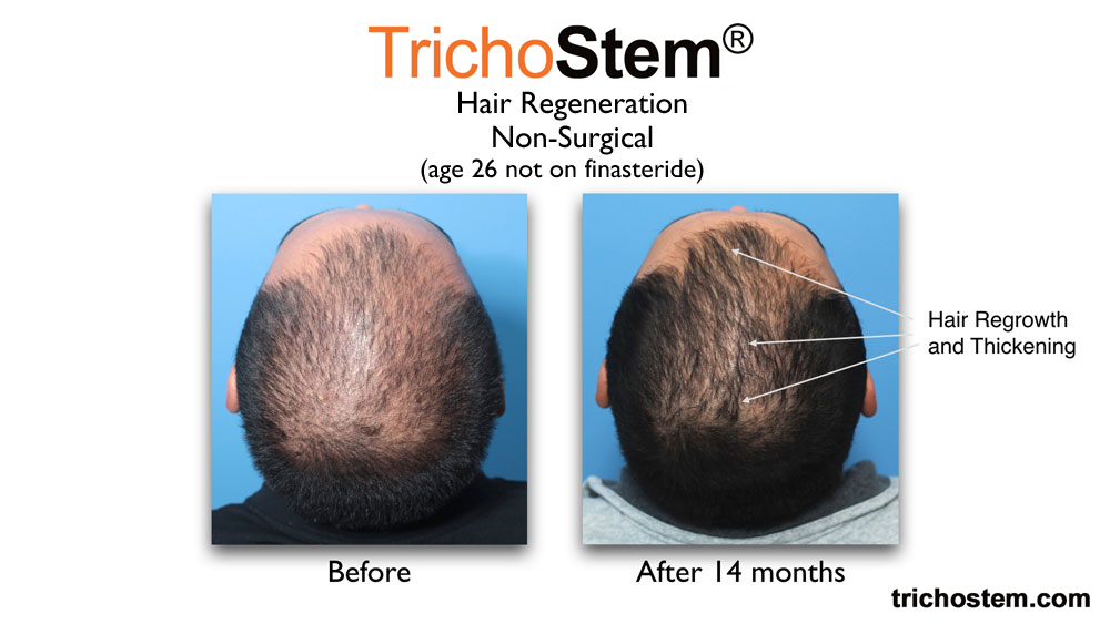 early male pattern hair loss treated with TrichoStem™ Hair Regeneration - before and after treatment comparison