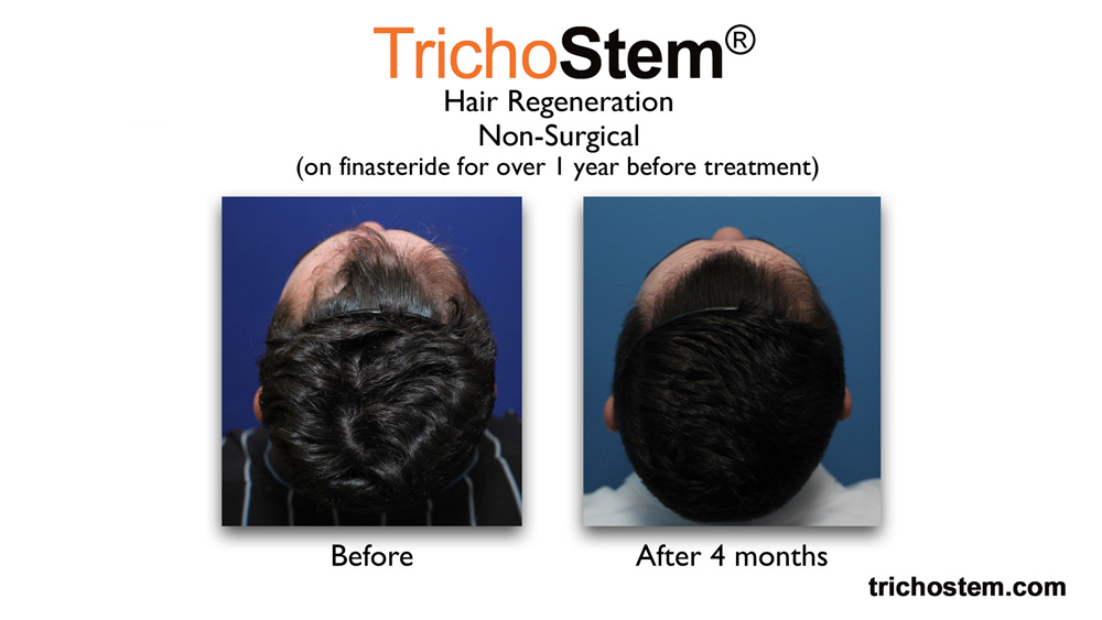 before and after TrichoStem™ Hair Regeneration. After photo shows the restored healthy hair growth of male patient