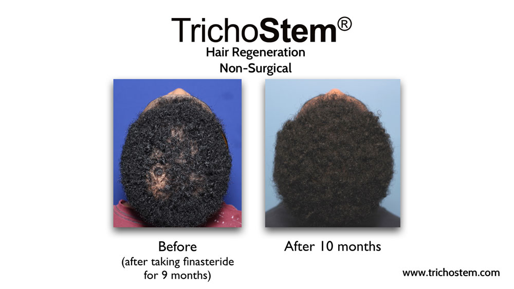 This male patient was taking finasteride for 9 months prior to TrichoStem® Hair Regeneration treatment to help with high DHT-sensitivity. The difference from finasteride treatment alone is clearly seen.