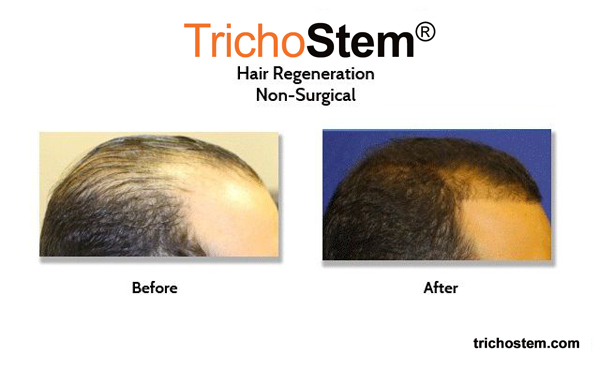  before and after ACell+PRP hair loss treatment