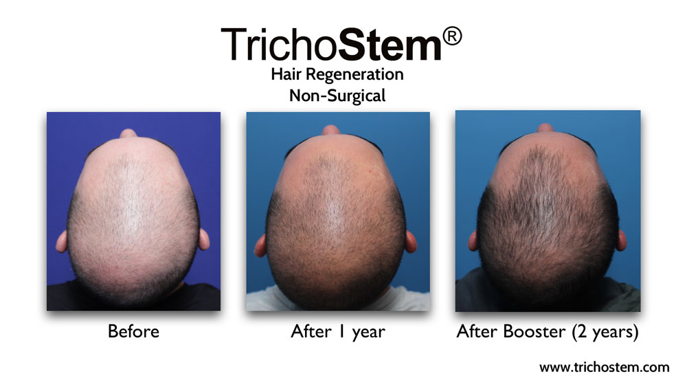 The TrichoStem® Hair Regeneration treatment plan includes the initial treatment, follow-up sessions, and a second treatment if necessary -- all for a one-time fee.