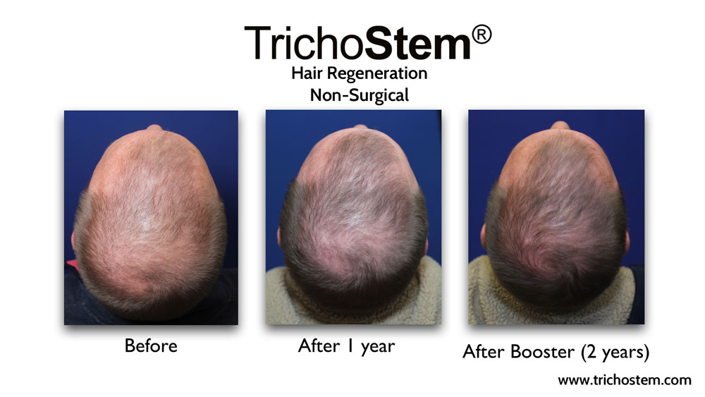 Male patient with significant thinning achieved considerably denser hair coverage after two TrichoStem® Hair Regeneration treatment sessions.