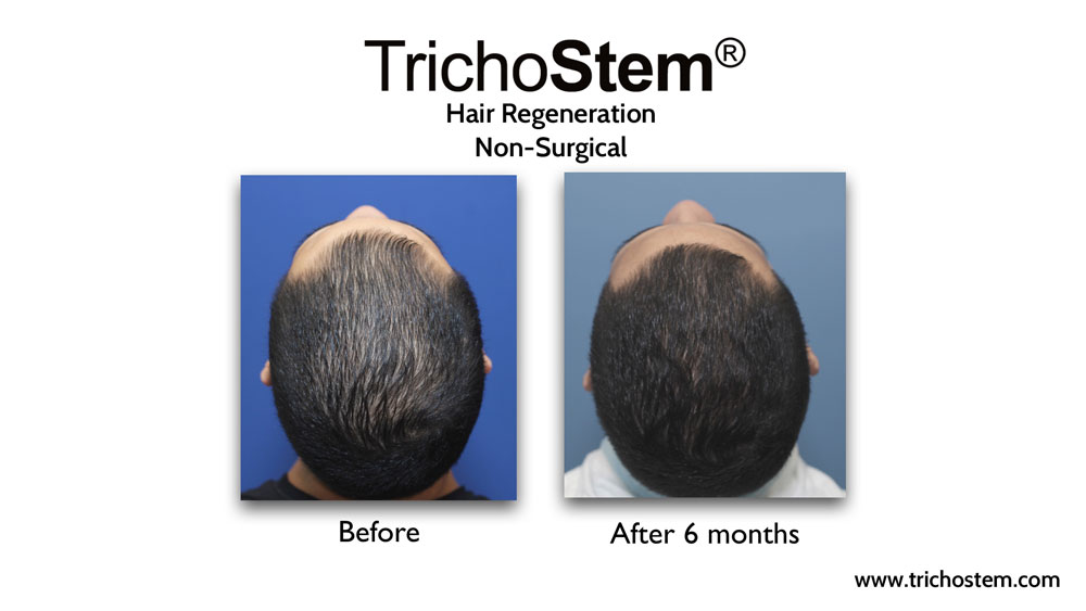 Effectiveness of TrichoStem® Hair Regeneration treatment after 6 months and a single injection