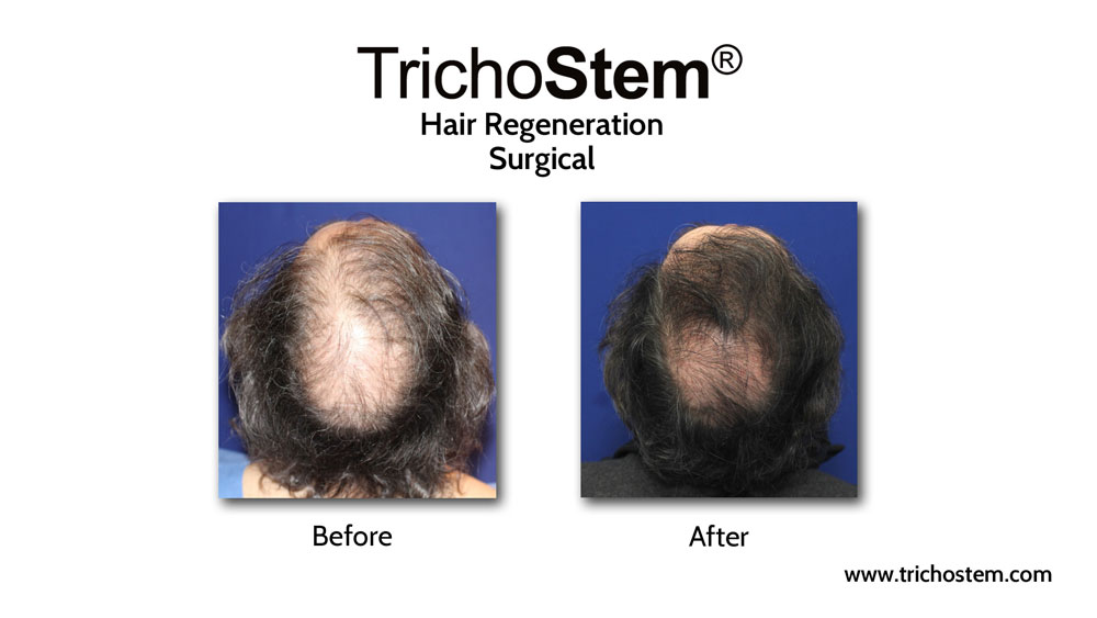 Prior to discovering TrichoStem® Hair Regeneration, Dr. Prasad already had extensive experience with hair loss treatment, including hair transplants and prescribing finasteride.