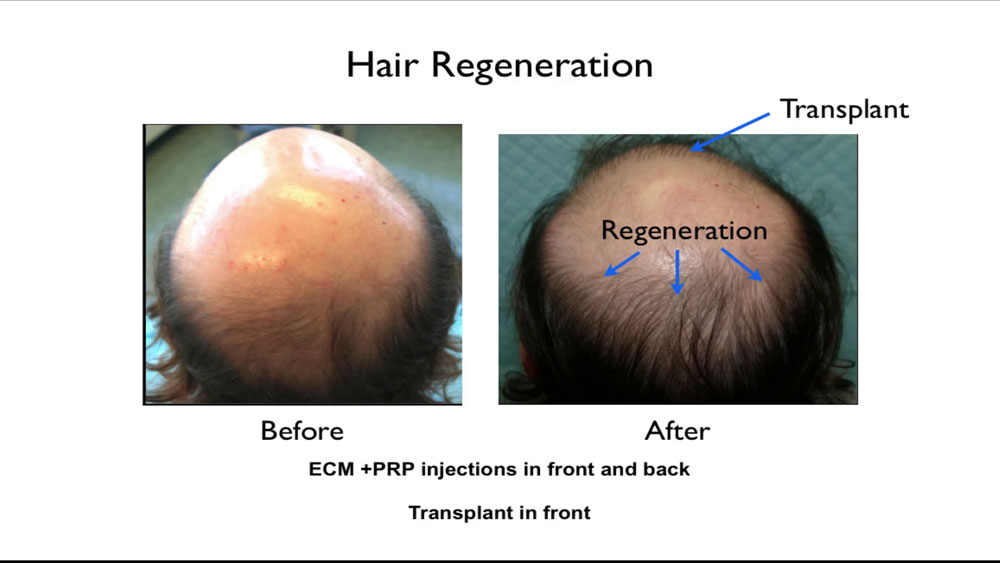 Dr. Prasad developed TrichoStem® Hair Regeneration after observing that extracellular matrix by ACell, when applied on transplanted hair grafts to facilitate healing, could also thicken existing thinning hairs.