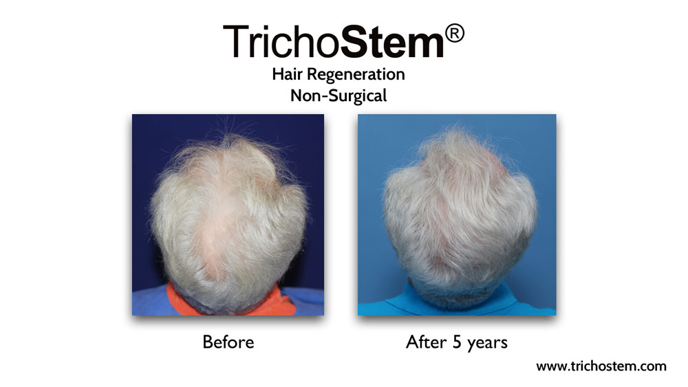 TrichoStem® Hair Regeneration results in a male patient with moderate hair thinning 5 years after a single injection and no finasteride.