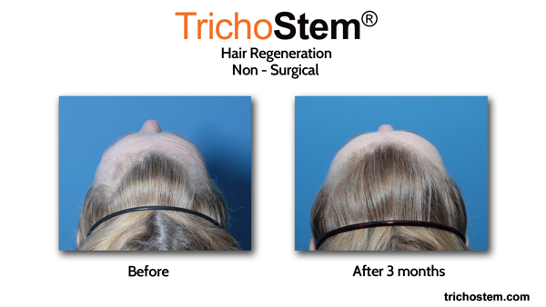 One of our female pattern hair loss patients, 3 months after a single injection of TrichoStem Hair Regeneration.