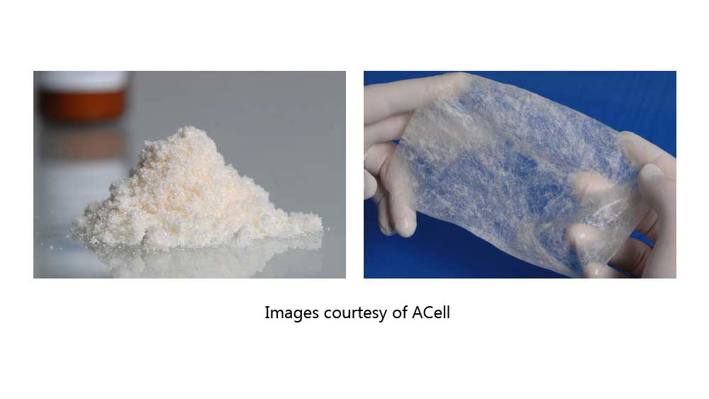 Extracellular matrix, or acellular matrix by ACell preparation