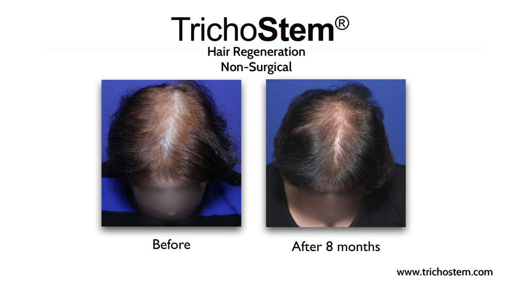 TrichoStem customized treatment formulations are more effective than standardized formulations