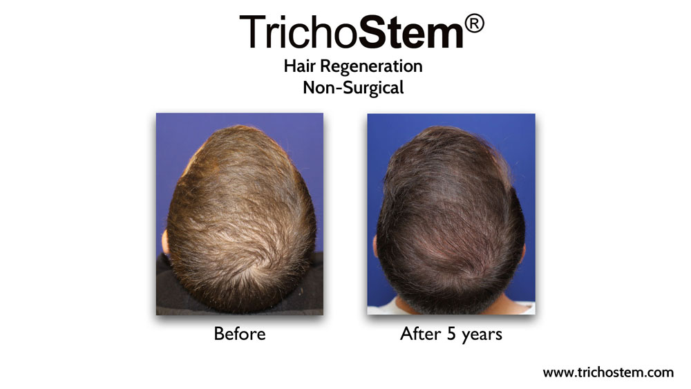 A male patient showing thicker scalp coverage five years after a single treatment of TrichoStem™ Hair Regeneration, and without using finasteride.