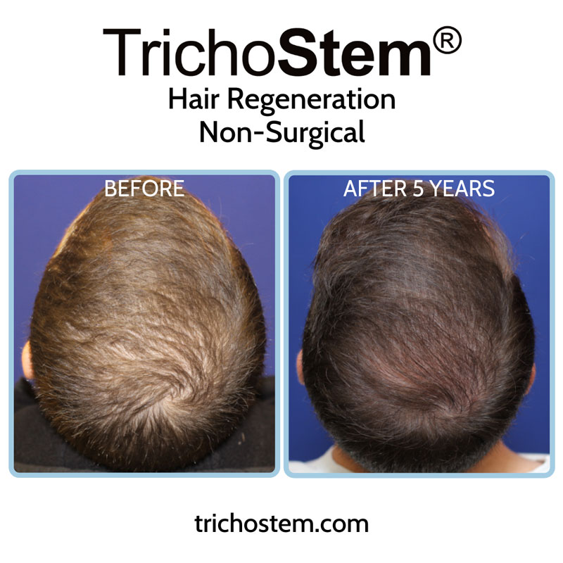 A male patient showing thicker scalp coverage five years after a single treatment of TrichoStem™ Hair Regeneration, and without using finasteride.