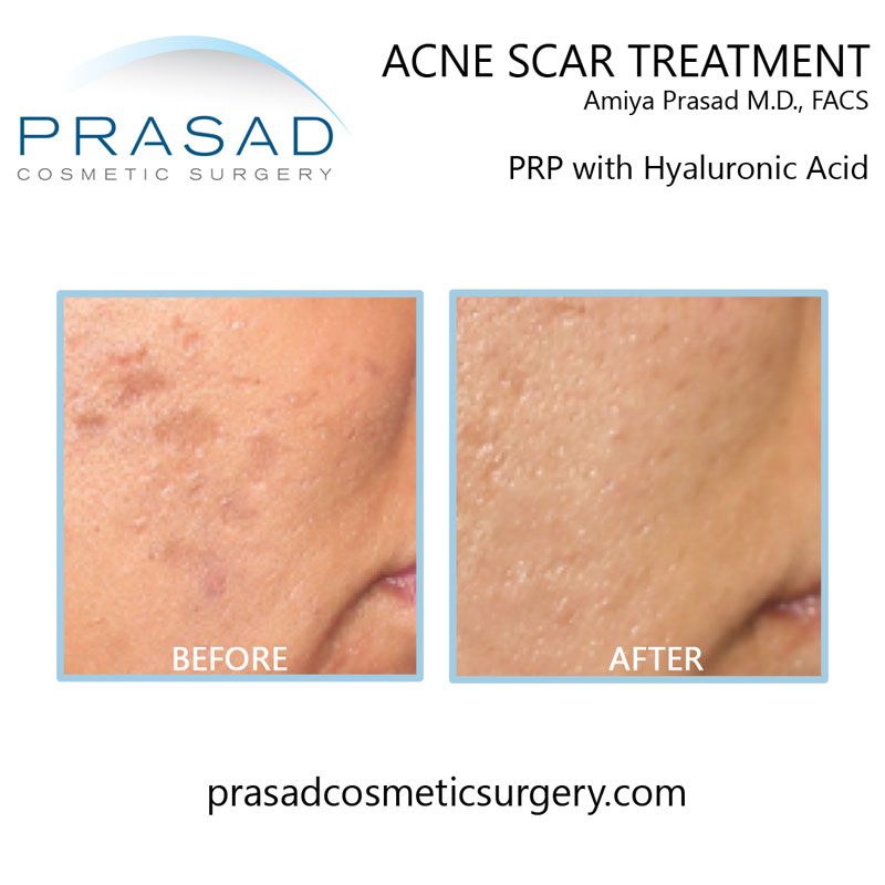 Dr. Amiya Prasad was one of the first cosmetic surgeons to adopt PRP in his practice for use in treating dark under eye circles, acne scars, and skin quality improvement. Acne scar treatment before and after