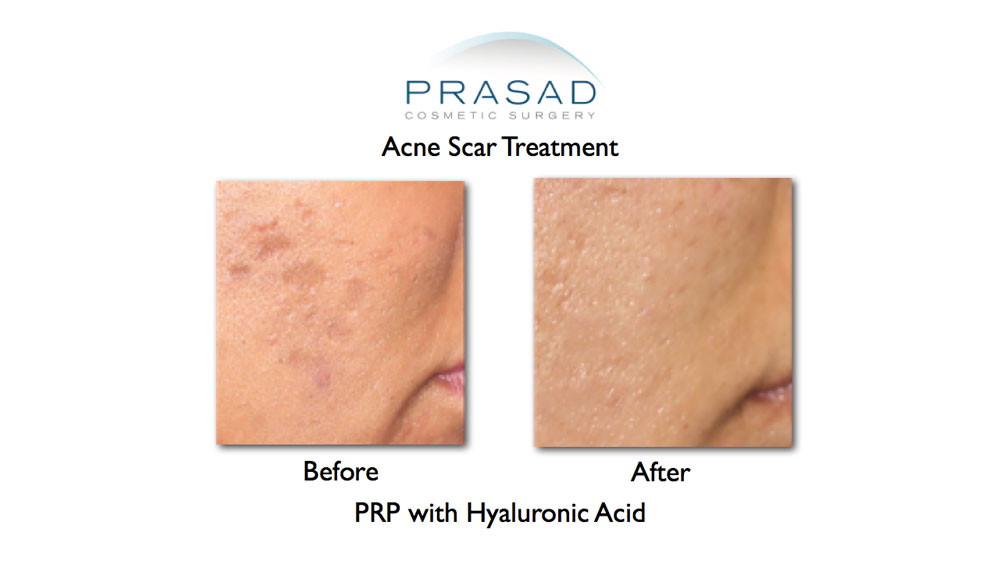 The regenerative quality and potential of PRP led Dr. Prasad to become one of its earliest advocates for skin rejuvenation and cosmetic medicine in 2008. Acne scar treatment with PRP before and after