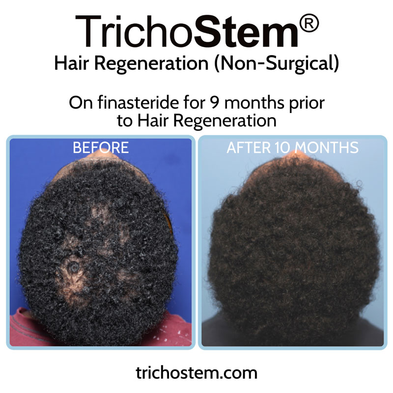 Male patient was taking finasteride for 9 months prior to TrichoStem® Hair Regeneration treatment to help with high DHT-sensitivity. The difference from finasteride treatment alone is clearly seen.