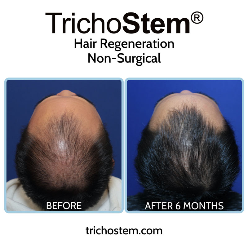 As pattern hair loss characteristics differ for individuals, these are factored in the customization of TrichoStem™ Hair Regeneration for each individual