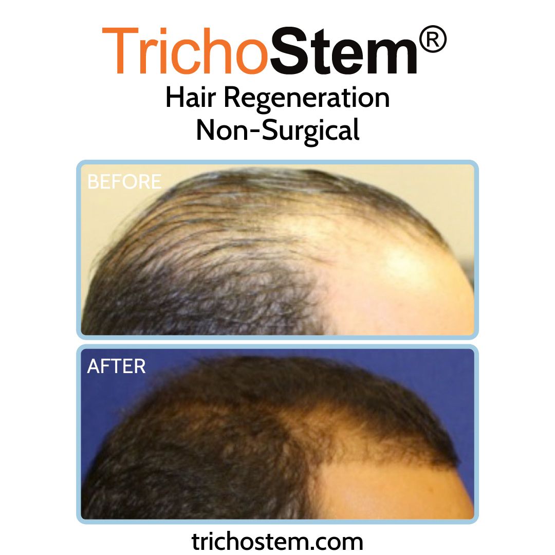 before and after hair loss treatment - patient results dated back 2011