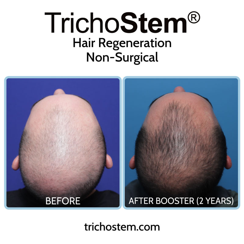 The TrichoStem® Hair Regeneration treatment plan includes the initial treatment, follow-up sessions, and a second treatment if necessary -- all for a one-time fee.