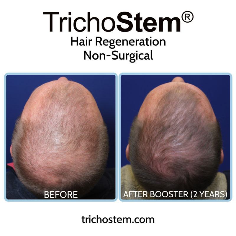 Male patient with significant thinning achieved considerably denser hair coverage after two TrichoStem® Hair Regeneration treatment sessions.