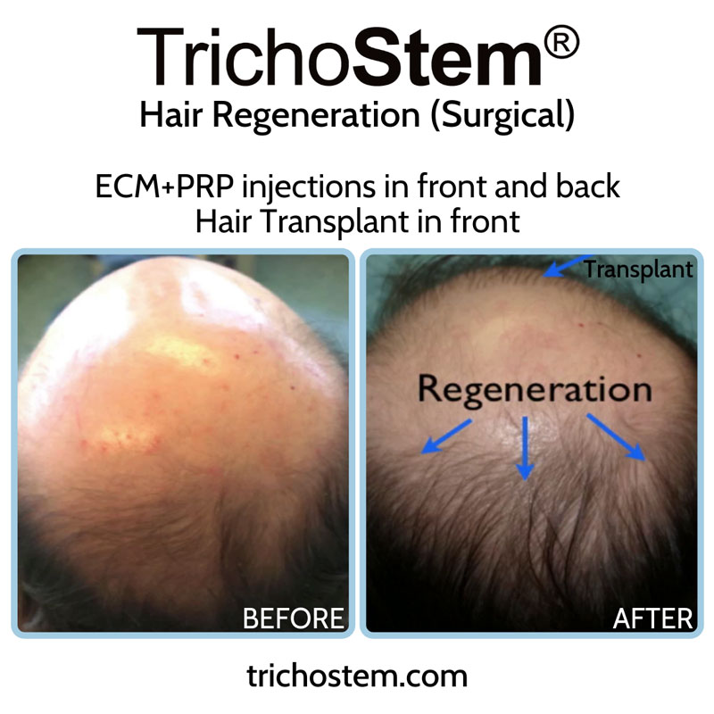 The original discovery by Dr. Amiya Prasadof the effects of ECM by ACell in a hair transplant patient growing thicker hair in non-transplanted areas