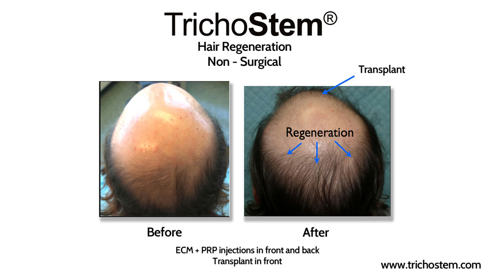 The original discovery by Dr. Amiya Prasad of the effects of ECM by ACell in a hair transplant patient growing thicker hair in non-transplanted areas