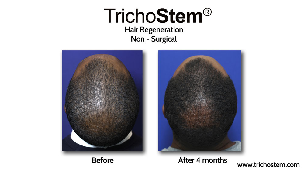 A male TrichoStem™Hair Regeneration patients showing increased scalp density and hair thickness 4 months after a single treatment session.