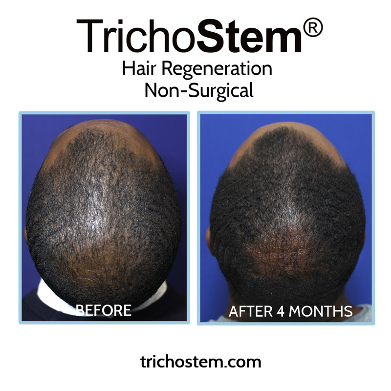 A male TrichoStem™Hair Regeneration patients showing increased scalp density and hair thickness 4 months after a single treatment session.