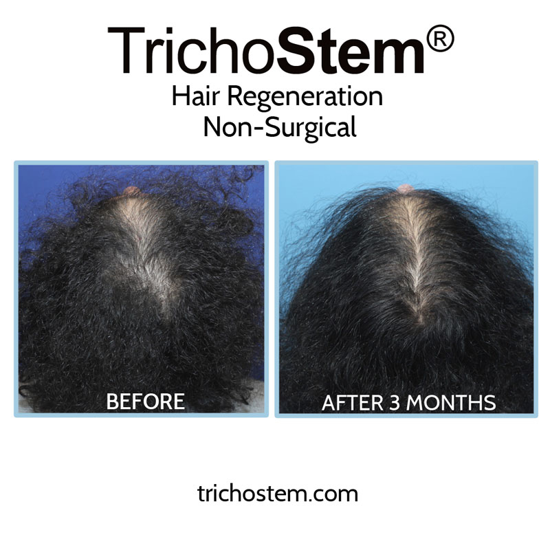 Male and female TrichoStem™ Hair Regeneration patients no longer need to use minoxidil, and women can stop using spironolactone
